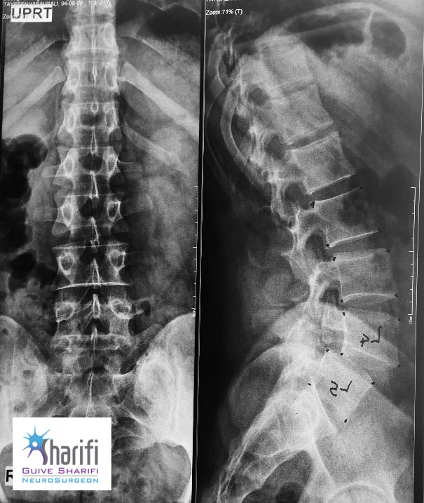 تنگی کانال نخاع کمری (Lumbar Spinal Stenosis)