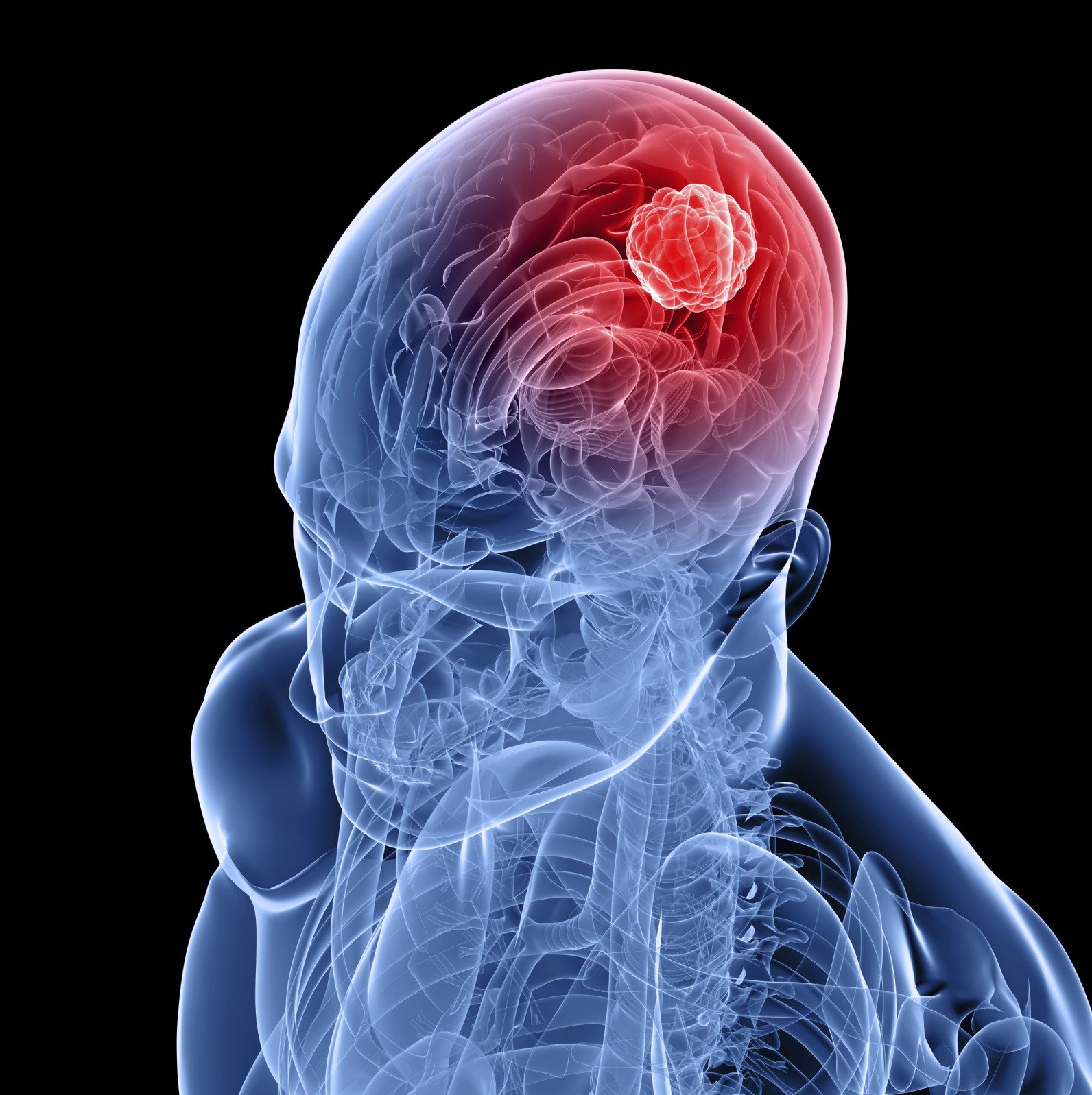 تومور مغزی | دکتر گیو شریفی