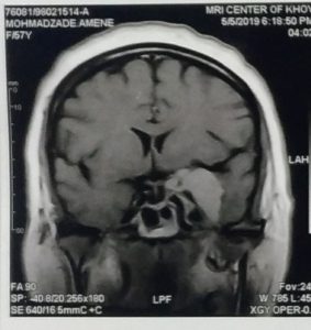 تومور بزرگ ناحیه کلینوئید و‌ کاورنوس چپ