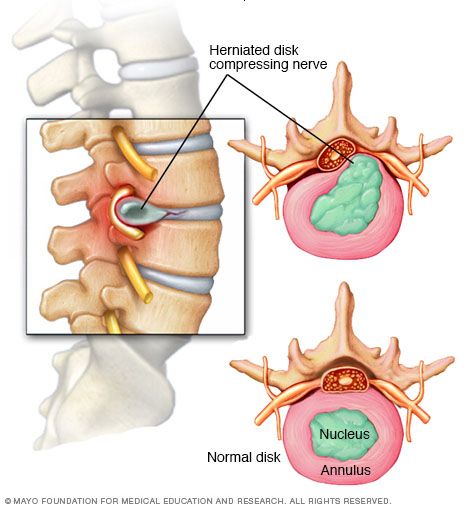 Lumbar disk disease