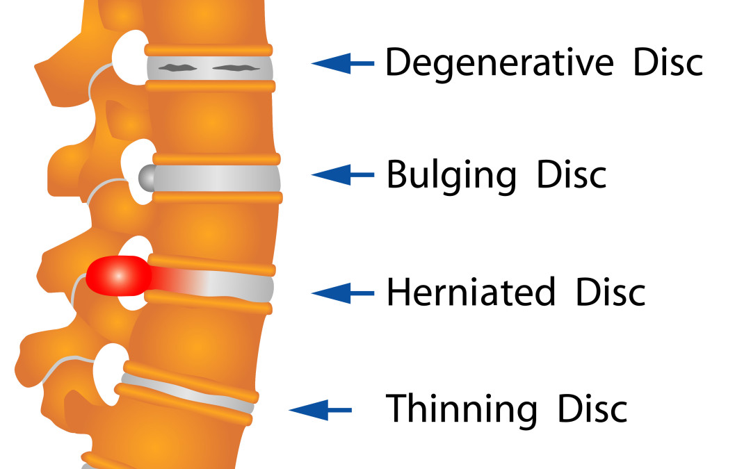 Lumbar disk disease