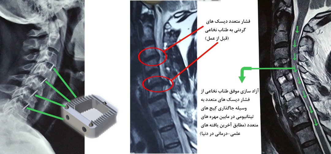 عمل دیسک های متعدد گردن بدون استفاده از پیچ و پلاک