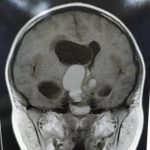 تومور بزرگ کرانیوفارنژیوما به همراه هیدروسفالی در کودک ۱۲ ساله