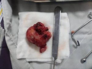 تومور گانگلیونوروبلاستوما