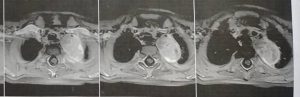 تومور گانگلیونوروبلاستوما