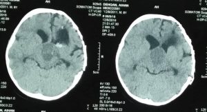 عمل تومور مغزی (کرانیوفارنژیوما) 