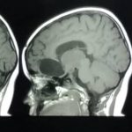 عمل تومور مغزی (کرانیوفارنژیوما) 