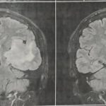 تومور گلیوم ناحیه اینسولا و تمپورال لوبکتومی