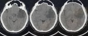 تومور گلیوم ناحیه اینسولا و تمپورال لوبکتومی