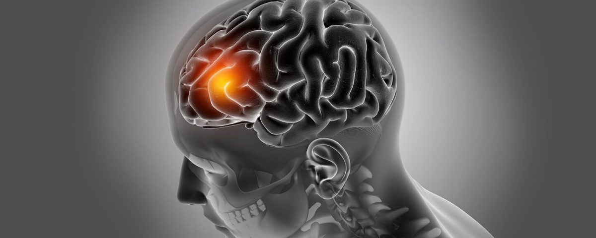 تومور مغز چیست؟