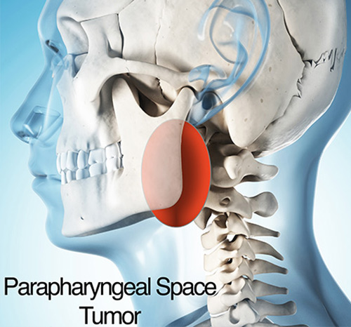 تومور پارافارنکس
