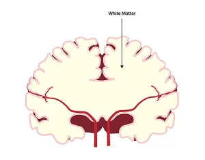 بیماری ماده سفید مغز