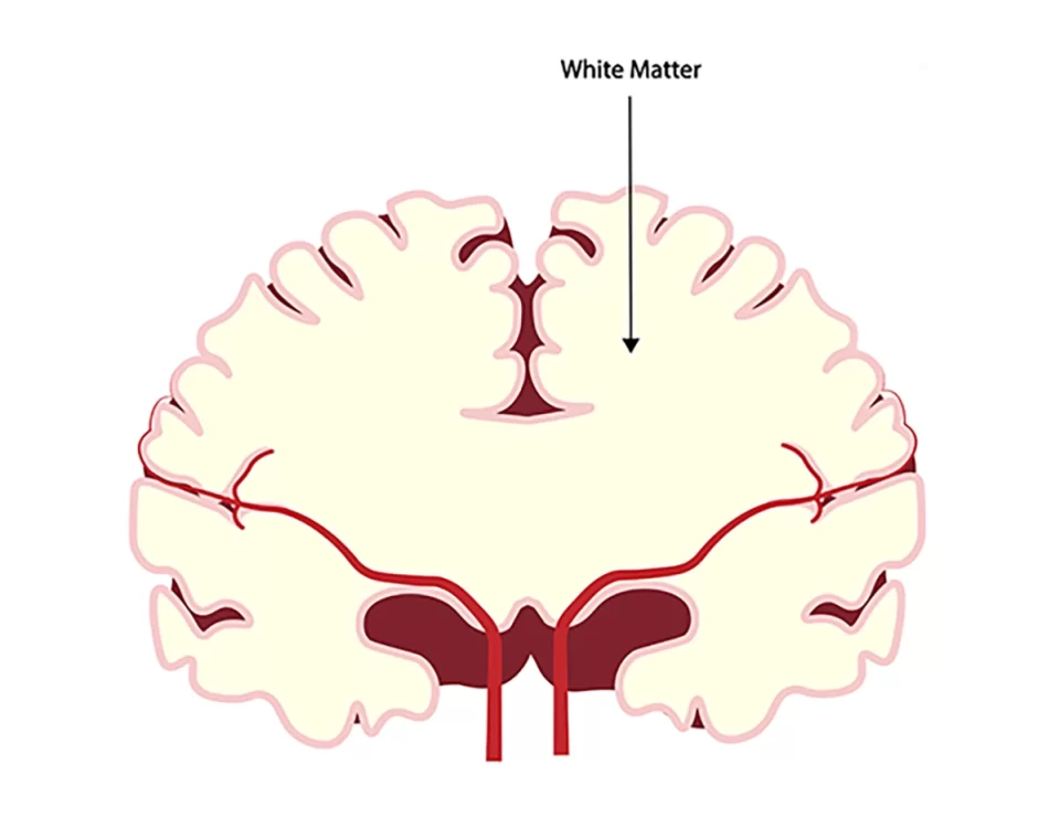 بیماری ماده سفید مغز
