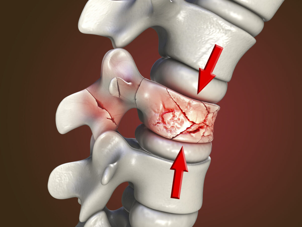 شکستگی ستون فقرات (شکستگی مهره ها)