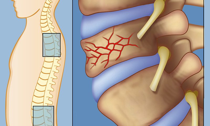 شکستگی ستون فقرات (شکستگی مهره ها)
