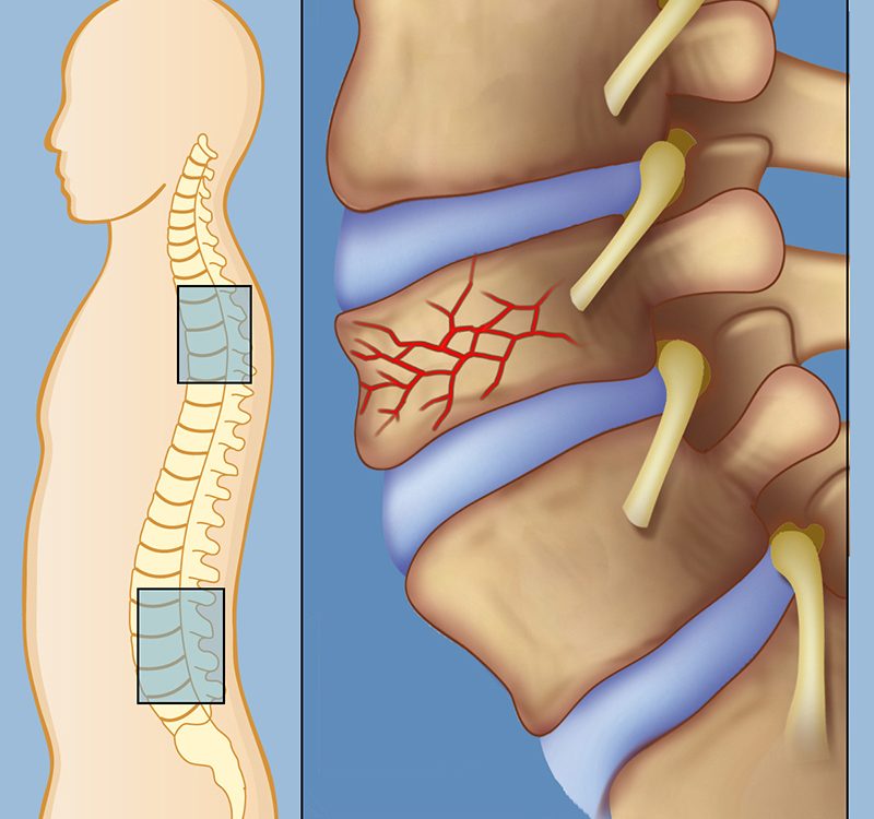 شکستگی ستون فقرات (شکستگی مهره ها)