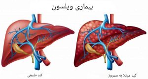 بیماری ویلسون