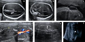 اختلالات لوله عصبی یا NTDs