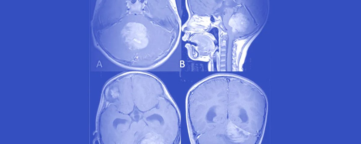 تومور مخچه مدولوبلاستوما