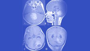 تومور مخچه مدولوبلاستوما