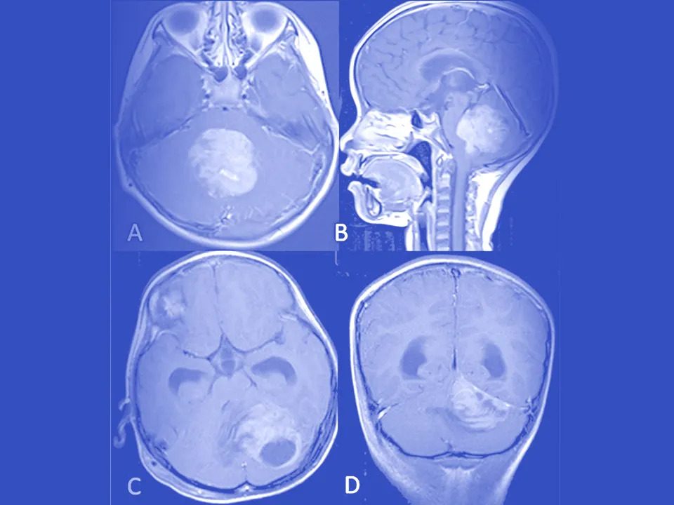 تومور مخچه مدولوبلاستوما
