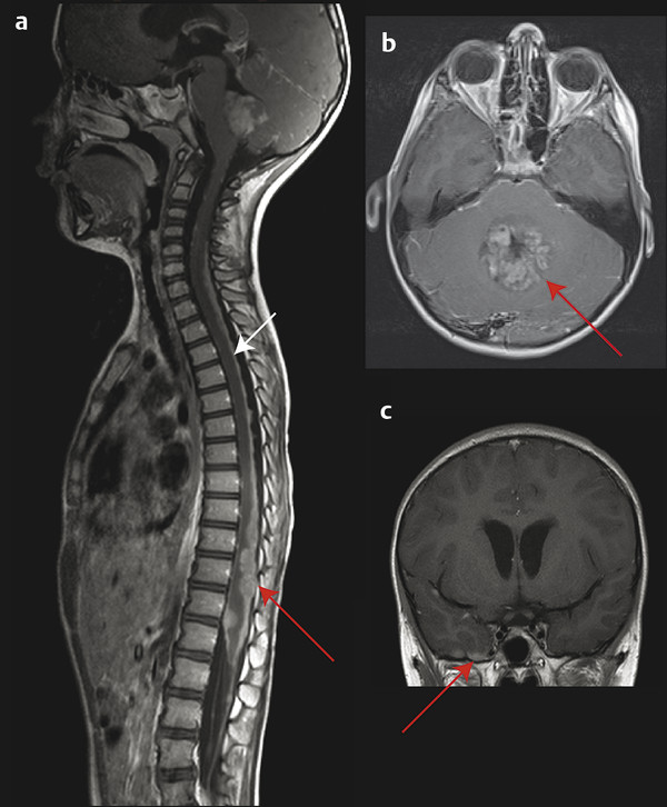 تومور مخچه مدولوبلاستوما