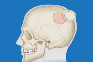 کرانیوتومی یا جراحی باز جمجمه