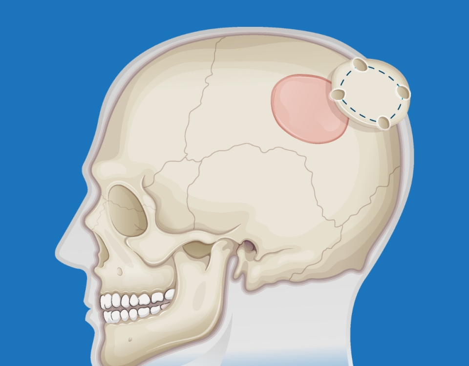 کرانیوتومی یا جراحی باز جمجمه