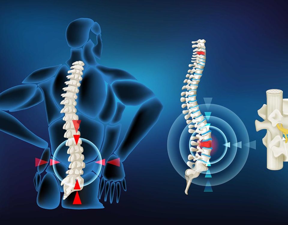 پارگی دیسک کمر