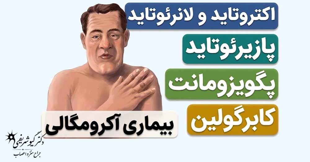 درمانهای غیرجراحی تومور هیپوفیز؛ چه زمانی میتوان بدون جراحی درمان کرد؟ 7 آکرومگالی