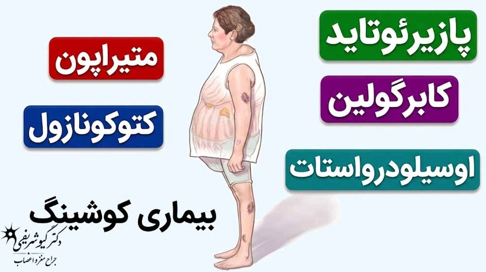 درمانهای غیرجراحی تومور هیپوفیز؛ چه زمانی میتوان بدون جراحی درمان کرد؟ 8 کوشینگ