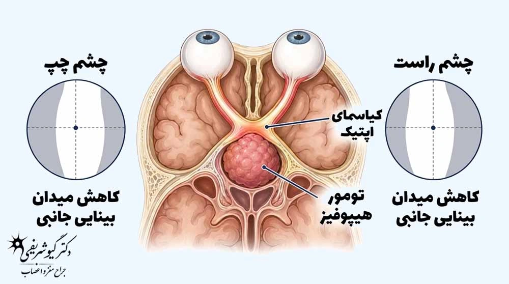 درمانهای غیرجراحی تومور هیپوفیز؛ چه زمانی میتوان بدون جراحی درمان کرد؟ 4 تومور هیپوفیز