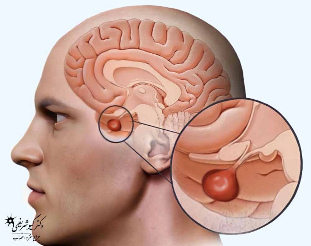 درمانهای غیرجراحی تومور هیپوفیز؛ چه زمانی میتوان بدون جراحی درمان کرد؟ 3 درمانهای غیرجراحی تومور هیپوفیز
