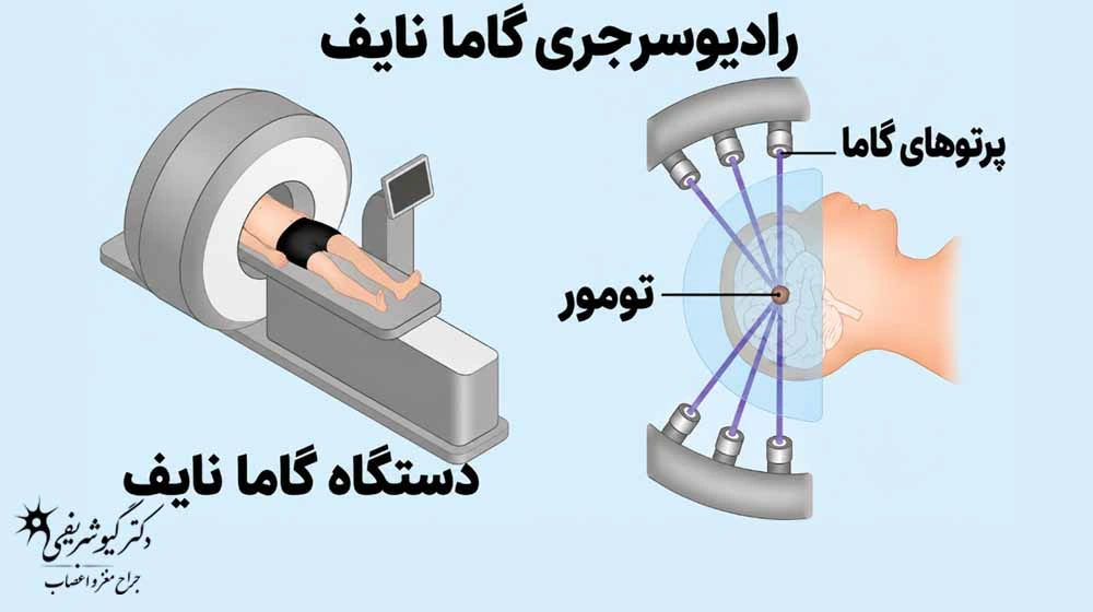 درمانهای غیرجراحی تومور هیپوفیز؛ چه زمانی میتوان بدون جراحی درمان کرد؟ 11 رادیوجراحی