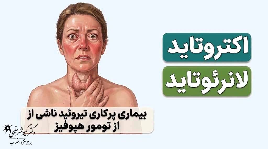 درمانهای غیرجراحی تومور هیپوفیز؛ چه زمانی میتوان بدون جراحی درمان کرد؟ 9 تومورهای ترشحکننده TSH