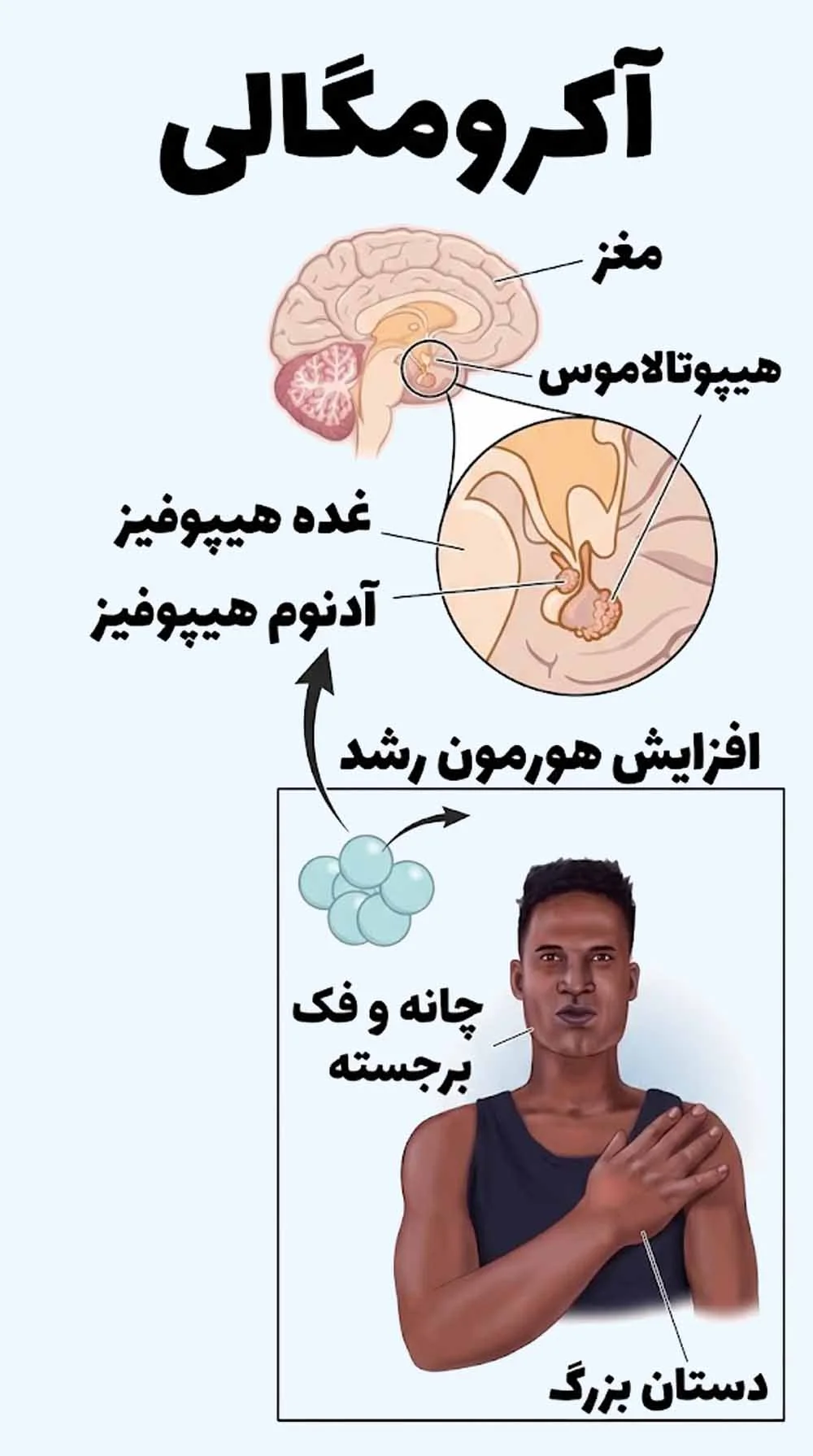 آکرومگالی