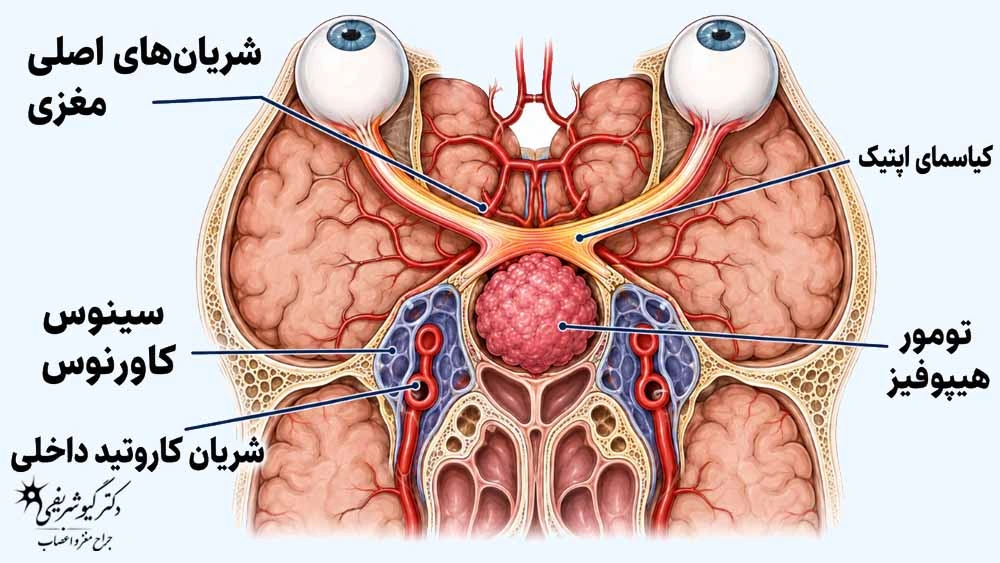 گسترش به بالای هیپوفیز