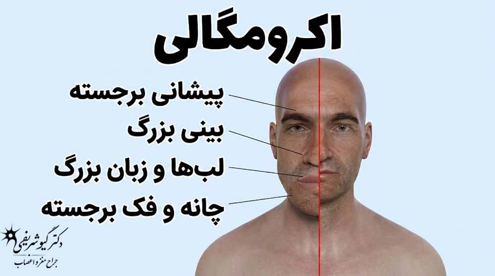 راهنمای کامل سؤالات متداول بیماران قبل از جراحی تومور هیپوفیز 7 کنترل هورمون رشد