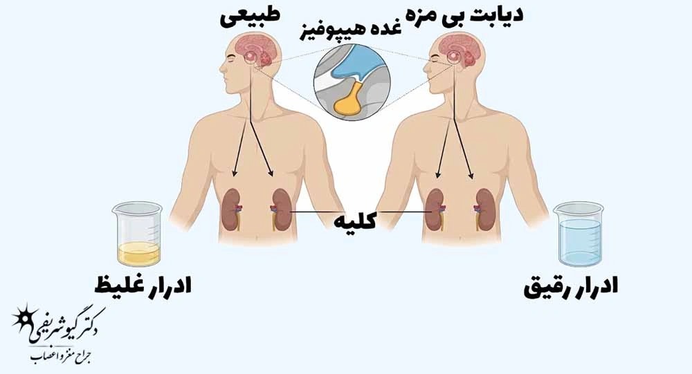 مراقبتهای بعد از جراحی هیپوفیز از راه بینی؛ اشتباهات رایج از هفته اول تا ماهها 2 حجم بالای ادرار