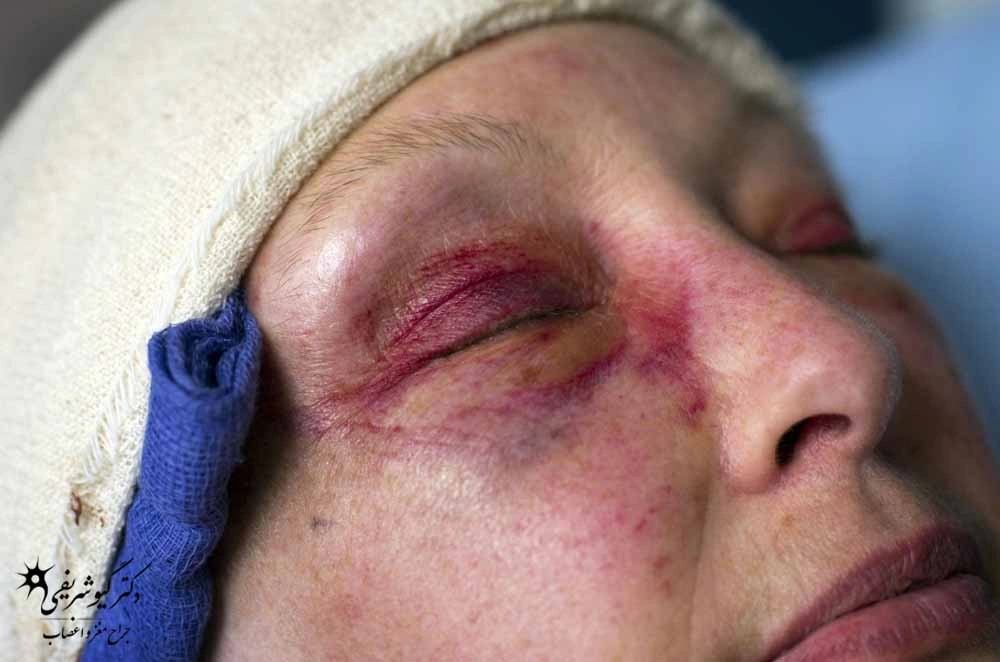 مدیریت تورم چشم و صورت