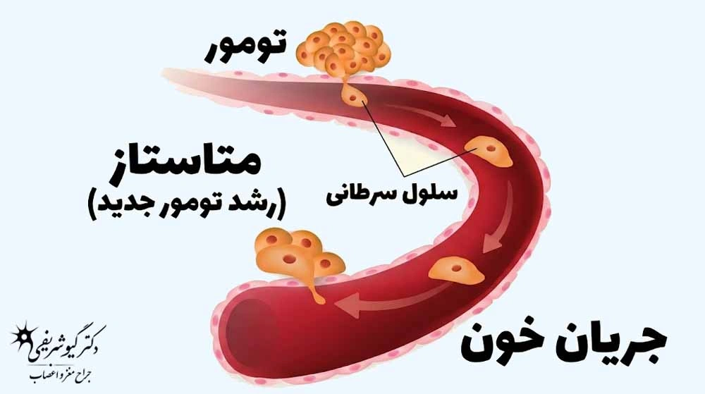 راهنمای کامل سؤالات متداول بیماران قبل از جراحی تومور هیپوفیز 4 متاستاز