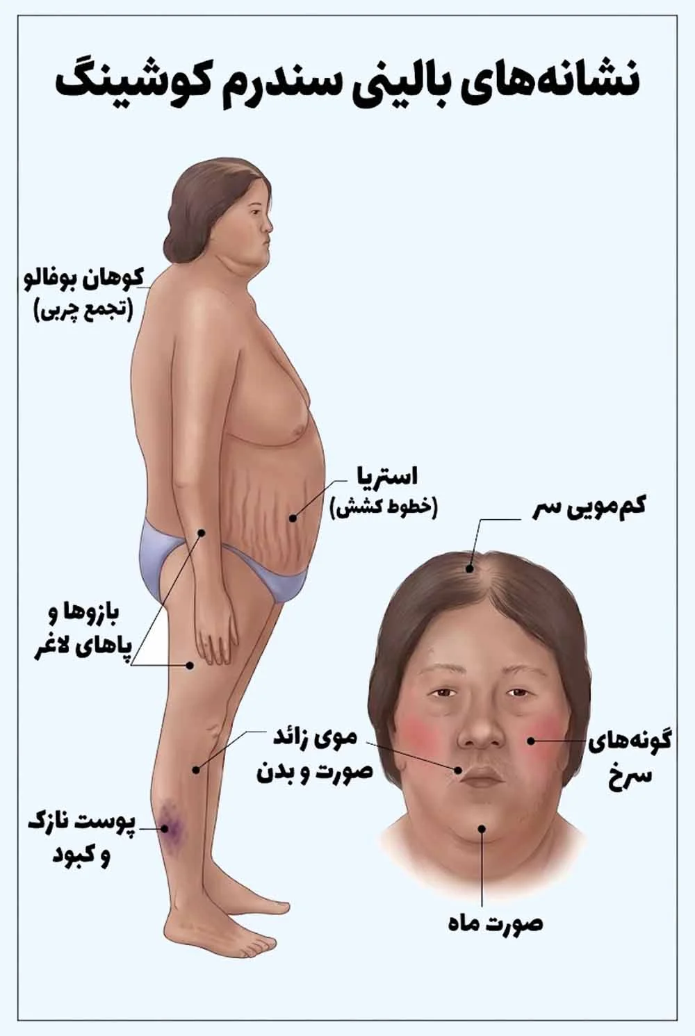 میکروآدنوم