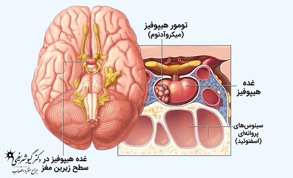 میکروآدنوم