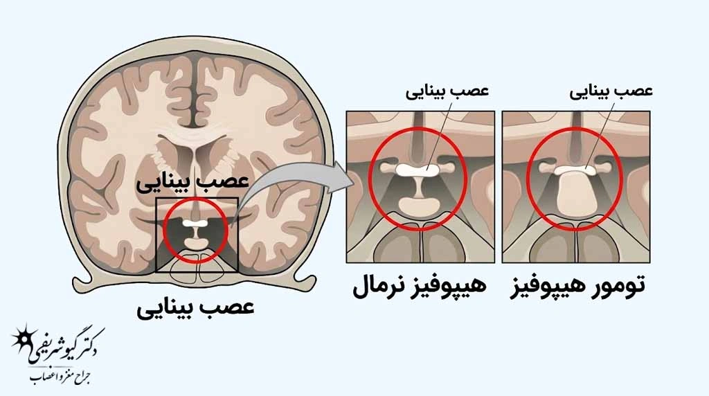 راهنمای کامل سؤالات متداول بیماران قبل از جراحی تومور هیپوفیز 6 عصب بینایی