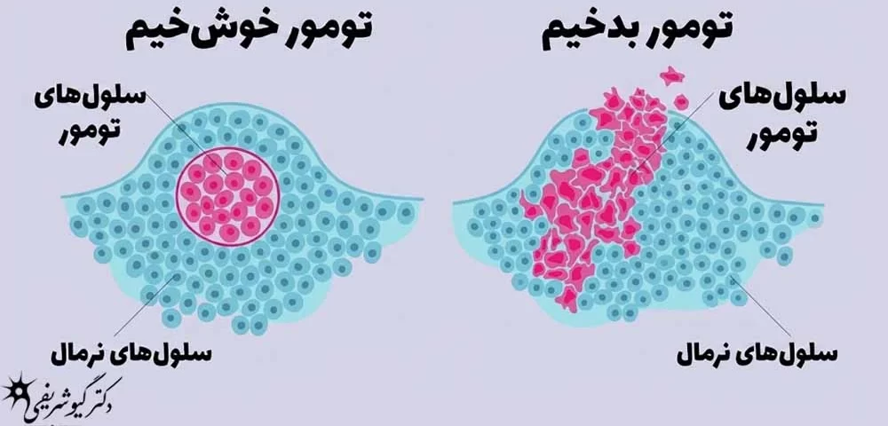 جراحی هیپوفیز