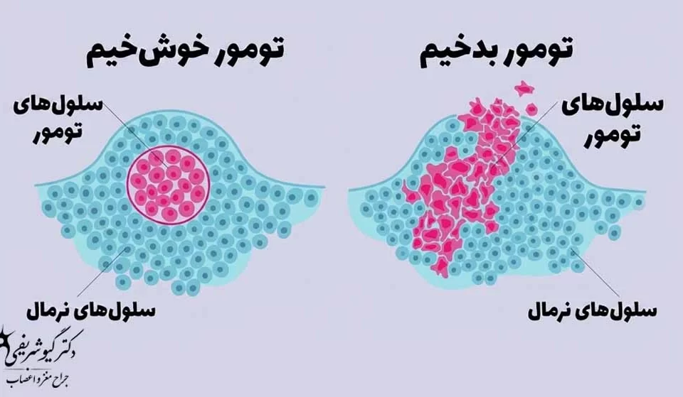 جراحی هیپوفیز