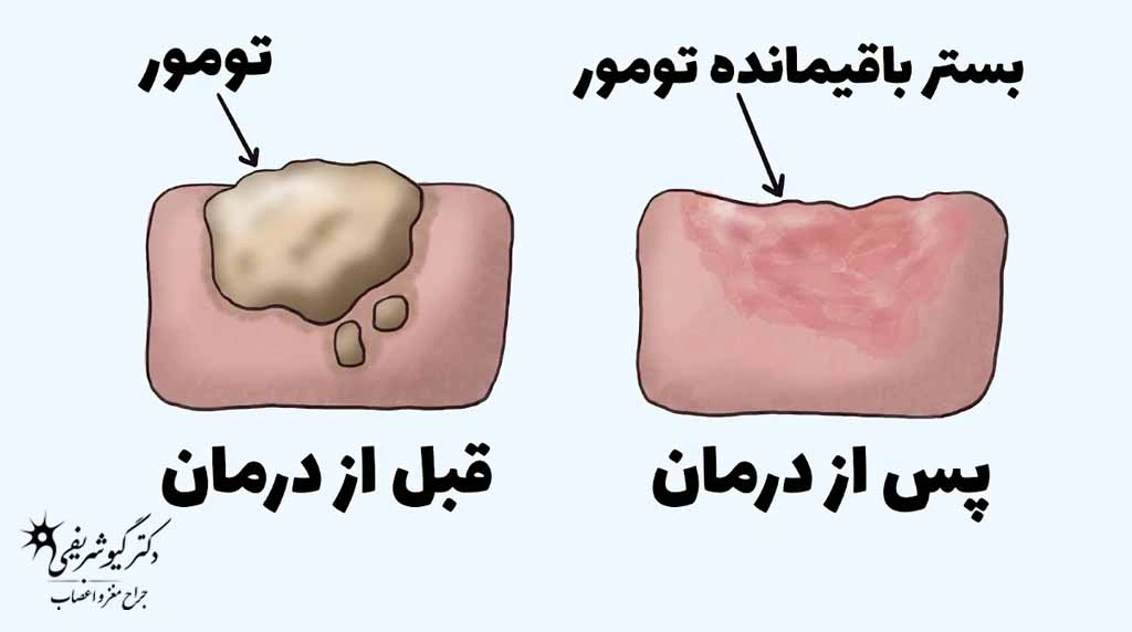 راهنمای کامل سؤالات متداول بیماران قبل از جراحی تومور هیپوفیز 5 تومور هیپوفیز