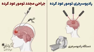تومور هیپوفیز