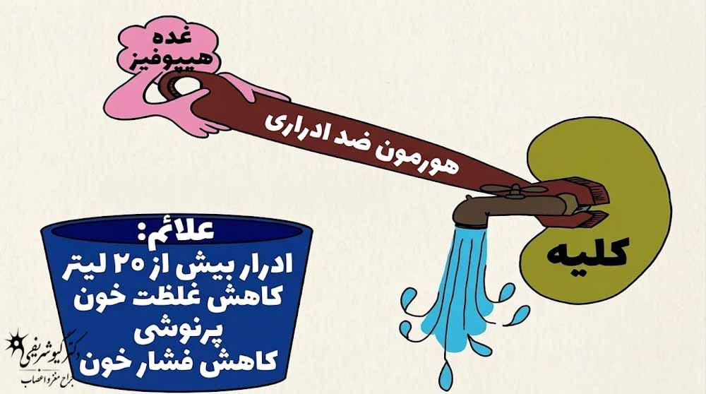 جراحی تومور هیپوفیز
