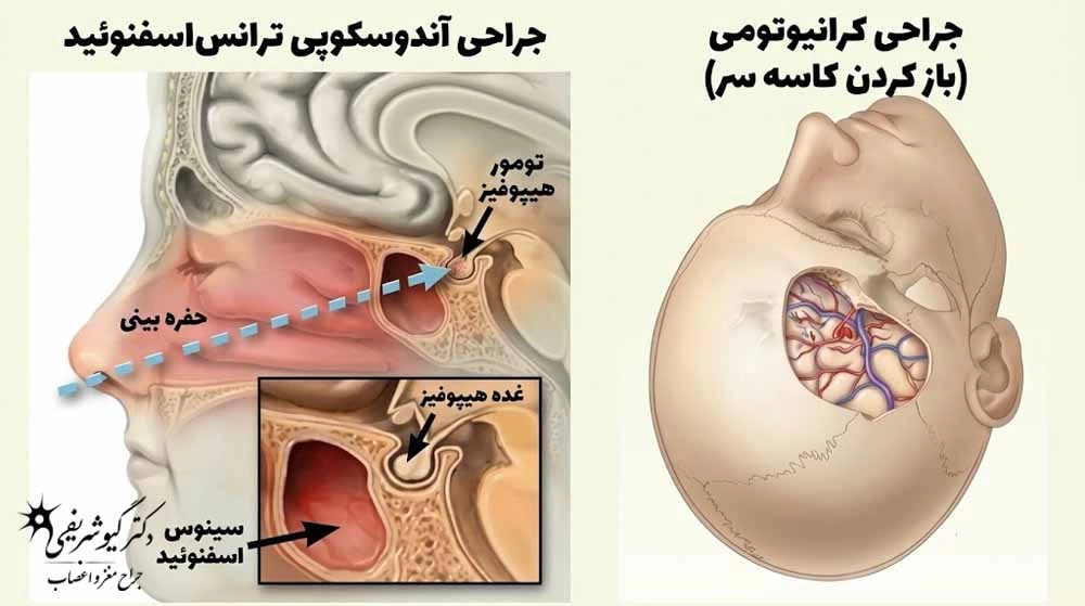 راهنمای کامل سؤالات متداول بیماران قبل از جراحی تومور هیپوفیز 8 جراحی تومور هیپوفیز